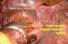 Laparoscopic anastomosis between colon and rectum