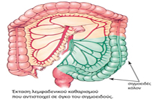 Extension of lymph node dissection for the sigmoid colon