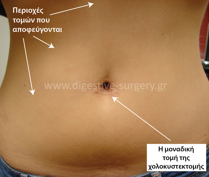 Single incision of a 21 year-old patient, 2 years postoperatively