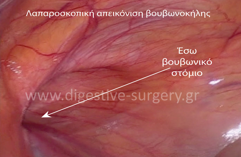 Laparoscopic view of an inguinal hernia