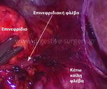 Adrenal Vein Dissection