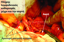Radical lymph node dissection