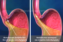 Normal and abnormal gastroesophageal valve-sphincter