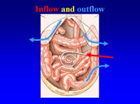 Chemotherapy inflow/outflow