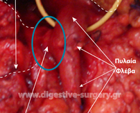 Portal vein involved in pancreatic cancer