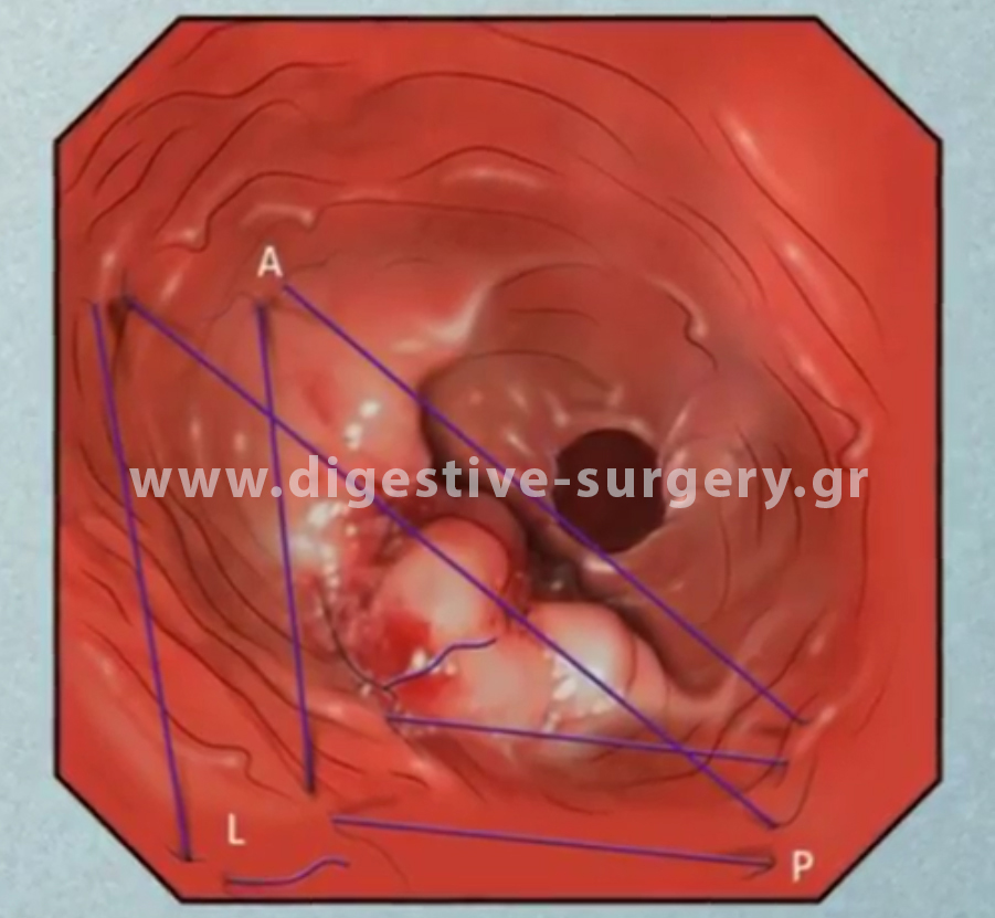 Endoscopic placement of triangular internal stitches for the reduction of the volume of the stomach