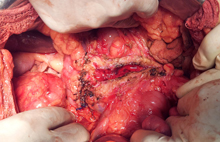 Opened pancreatic duct during an operation for chronic pancreatitis