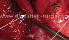 Τangential excision and reconstruction of the portal vein infiltrated with pancreatic cancer - frozen section with positive margins