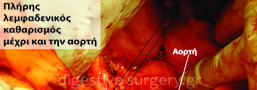 Appropriate lymph node dissection during gastrectomy for cancer