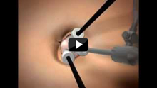  ΛSingle-incision laparoscopic cholecystectomy (SILS) 