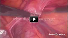 Laparoscopic reduction of the inguinal hernia sack