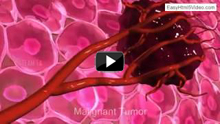 Malignant tumor development